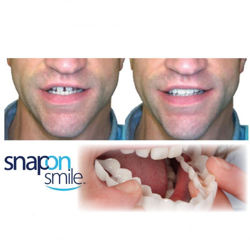 SNAP-ON SMILE, IDEIGLENES ALSÓ-FELSŐ KOZMETIKAI FOGHÍD