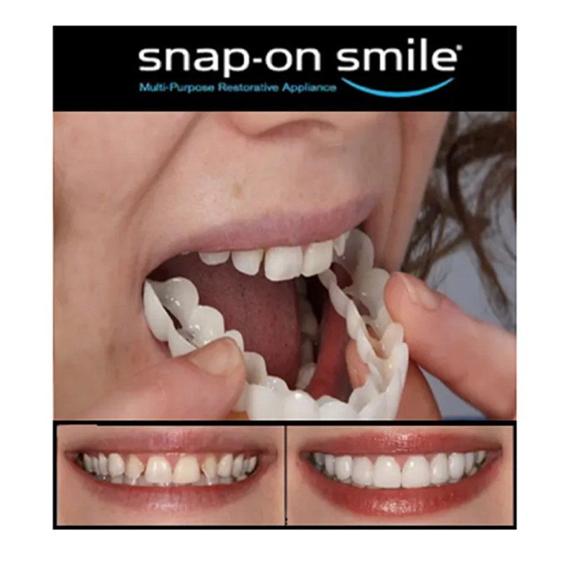 SNAP-ON SMILE, IDEIGLENES ALSÓ-FELSŐ KOZMETIKAI FOGHÍD